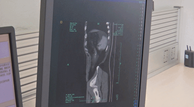 Vỡ bàng quang vì uống quá nhiều bia mà không đi vệ sinh - Ảnh 1. Vỡ bàng quang vì uống quá nhiều bia mà không đi vệ sinh - Ảnh 1.