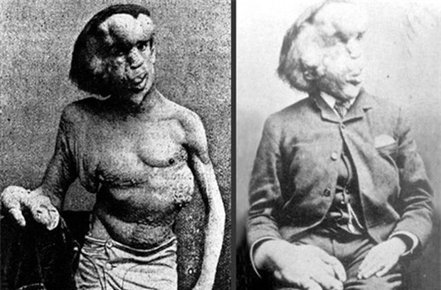 Cuộc đời đau khổ và ngắn ngủi của Người voi: Sinh ra mang vẻ ngoài khác biệt với những khối u lớn bí ẩn không lời giải đến tận ngày nay - Ảnh 2. Cuộc đời đau khổ và ngắn ngủi của Người voi: Sinh ra mang vẻ ngoài khác biệt với những khối u lớn bí ẩn không lời giải đến tận ngày nay - Ảnh 2.
