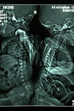 Cặp song sinh người Xi&ecirc;m sau 20 năm sau phẫu thuật t&aacute;ch cột sống "triệu ca c&oacute; một" giờ ra sao? - Ảnh 3.