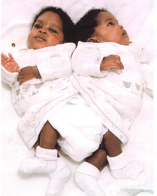 Cặp song sinh người Xiêm sau 20 năm sau phẫu thuật tách cột sống "triệu ca có một" giờ ra sao? - Ảnh 2. Cặp song sinh người Xiêm sau 20 năm sau phẫu thuật tách cột sống "triệu ca có một" giờ ra sao? - Ảnh 2.