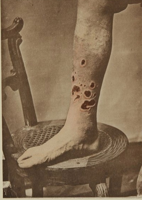 Th&iacute; nghiệm Tuskegee: Giết người v&igrave; khoa học? - Ảnh 5.