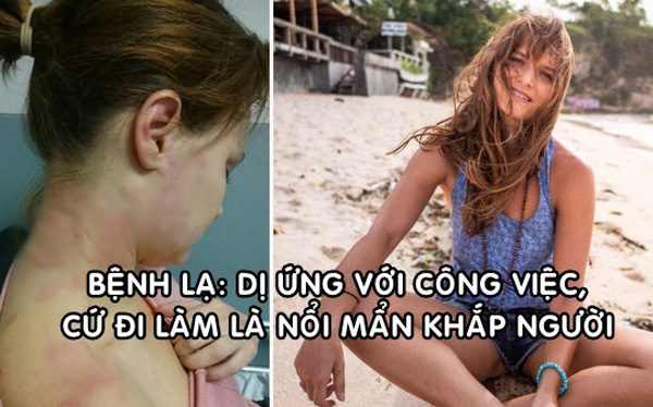 C&ocirc; g&aacute;i mắc bệnh dị ứng nặng với... c&ocirc;ng việc, bỏ l&agrave;m chu du khắp thế giới liền khỏi bệnh - Ảnh 1.