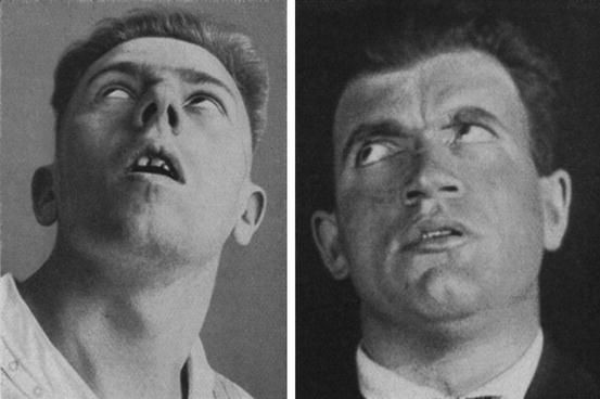 Viêm não buồn ngủ - một trong những dịch bệnh khó hiểu nhất của thế kỷ 20! - Ảnh 6. Viêm não buồn ngủ - một trong những dịch bệnh khó hiểu nhất của thế kỷ 20! - Ảnh 6.