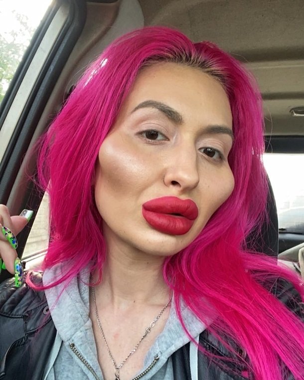 Chi 52 triệu đồng để sửa gò má và bơm môi, cô gái Ukraine đã biến đổi khuôn mặt mình như thế nào? - Ảnh 1. Chi 52 triệu đồng để sửa gò má và bơm môi, cô gái Ukraine đã biến đổi khuôn mặt mình như thế nào? - Ảnh 1.