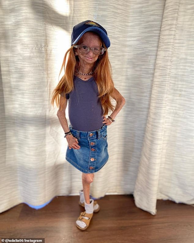 Adalia Rose: Benjamin Button ngoài đời thực, người đã truyền cảm hứng cho hàng triệu người và cái chết ở tuổi 15 - Ảnh 5. Adalia Rose: Benjamin Button ngoài đời thực, người đã truyền cảm hứng cho hàng triệu người và cái chết ở tuổi 15 - Ảnh 5.