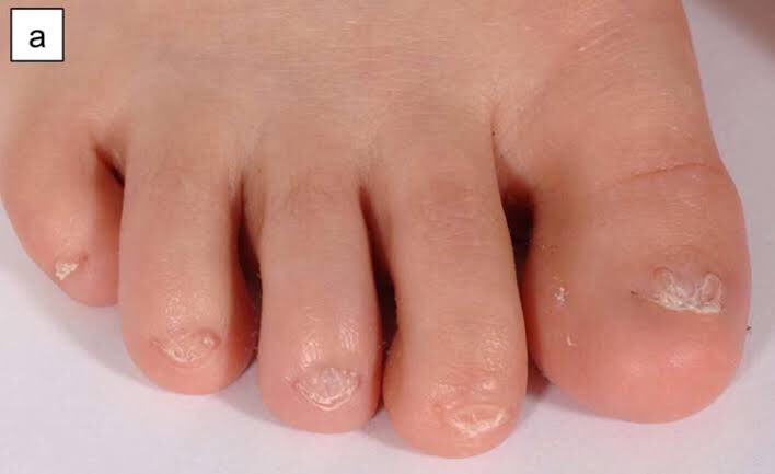 Anonychia – Một tình trạng hiếm gặp, khiến cho con người không có móng tay và móng chân - Ảnh 2. Anonychia – Một tình trạng hiếm gặp, khiến cho con người không có móng tay và móng chân - Ảnh 2.
