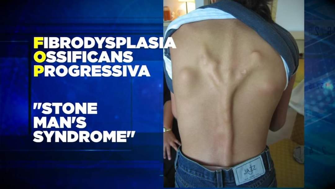 Anonychia – Một tình trạng hiếm gặp, khiến cho con người không có móng tay và móng chân - Ảnh 4. Anonychia – Một tình trạng hiếm gặp, khiến cho con người không có móng tay và móng chân - Ảnh 4.