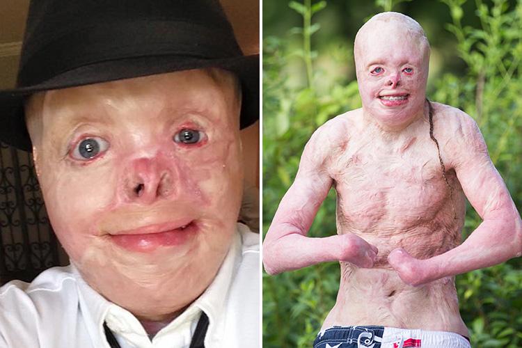 Cậu bé “người ngoài hành tinh” bị bỏng 95% cơ thể khiến cả thế giới thương cảm một thời giờ ra sao? Hình ảnh hiện tại rất đáng khâm phục - Ảnh 4. Cậu bé “người ngoài hành tinh” bị bỏng 95% cơ thể khiến cả thế giới thương cảm một thời giờ ra sao? Hình ảnh hiện tại rất đáng khâm phục - Ảnh 4.