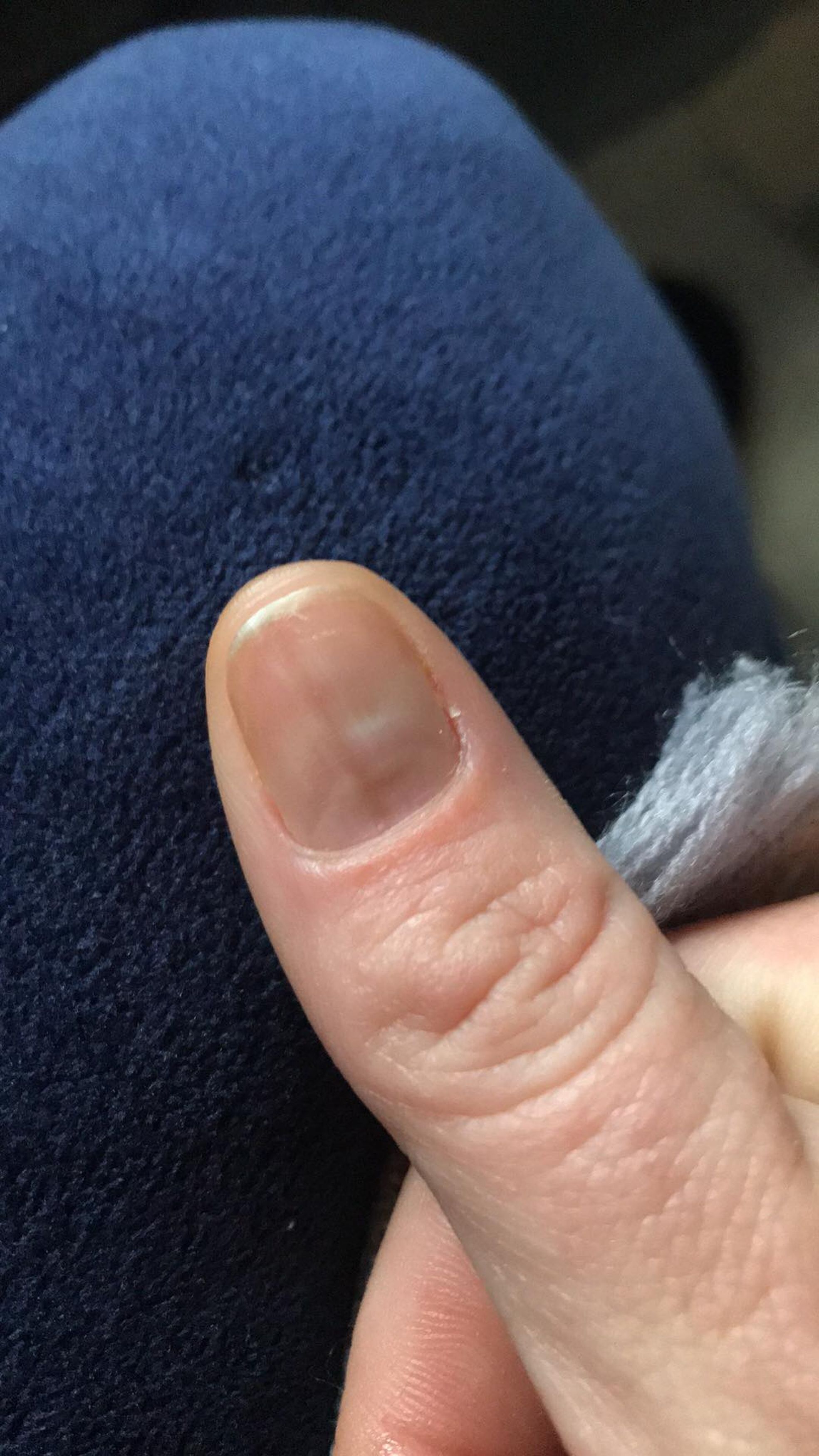 Vệt kẻ trông như nét bút chì dưới móng tay lại có thể là dấu hiệu cho thấy bạn đang mắc ung thư- Ảnh 2. Vệt kẻ trông như nét bút chì dưới móng tay lại có thể là dấu hiệu cho thấy bạn đang mắc ung thư- Ảnh 2.