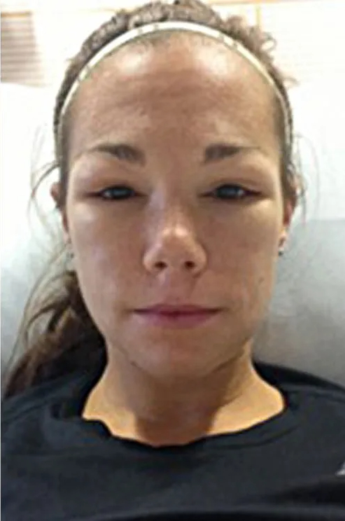 Dị ứng với tập thể dục là có thật: Từ ngứa, sốc phản vệ tới tử vong, bạn cần đặc biệt cảnh giác nếu có các triệu chứng sau- Ảnh 3. Dị ứng với tập thể dục là có thật: Từ ngứa, sốc phản vệ tới tử vong, bạn cần đặc biệt cảnh giác nếu có các triệu chứng sau- Ảnh 3.