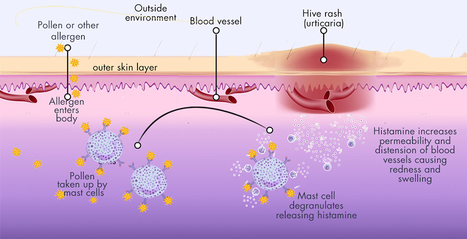 Dị ứng với tập thể dục là có thật: Từ ngứa, sốc phản vệ tới tử vong, bạn cần đặc biệt cảnh giác nếu có các triệu chứng sau- Ảnh 4. Dị ứng với tập thể dục là có thật: Từ ngứa, sốc phản vệ tới tử vong, bạn cần đặc biệt cảnh giác nếu có các triệu chứng sau- Ảnh 4.