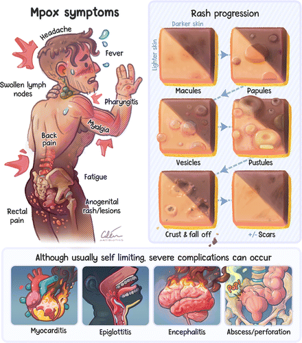 WHO tuy&ecirc;n bố đậu m&ugrave;a khỉ l&agrave; t&igrave;nh trạng khẩn cấp to&agrave;n cầu: Đ&acirc;y l&agrave; những g&igrave; bạn cần biết- Ảnh 2.