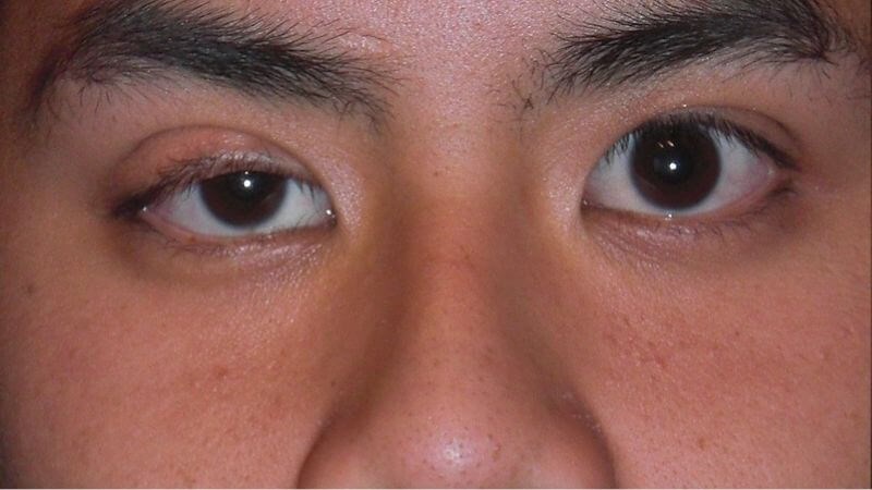 Đừng bỏ qua những triệu chứng này ở mắt, đó có thể là dấu hiệu cho thấy một khối u đang âm thầm phát triển trong cơ thể bạn- Ảnh 4. Đừng bỏ qua những triệu chứng này ở mắt, đó có thể là dấu hiệu cho thấy một khối u đang âm thầm phát triển trong cơ thể bạn- Ảnh 4.