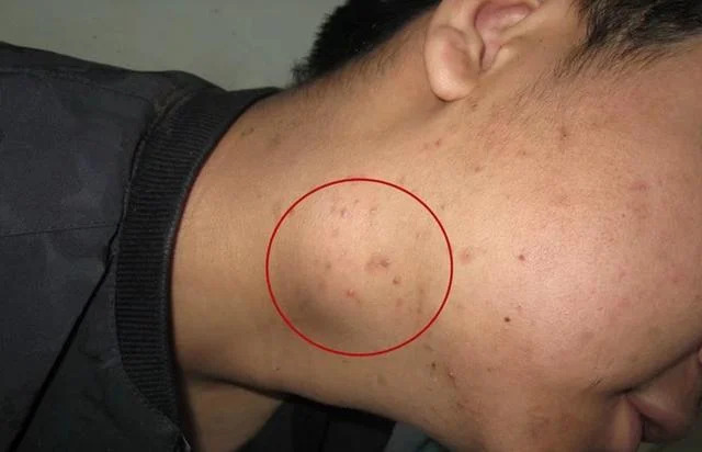 Loại ung thư c&oacute; thể xuất hiện ở bất cứ vị tr&iacute; n&agrave;o tr&ecirc;n cơ thể, kh&ocirc;ng để &yacute; 5 dấu hiệu n&agrave;y dễ "hối kh&ocirc;ng kịp"- Ảnh 1.