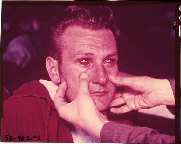 Trường hợp nặng - mắt gần như bị mù.