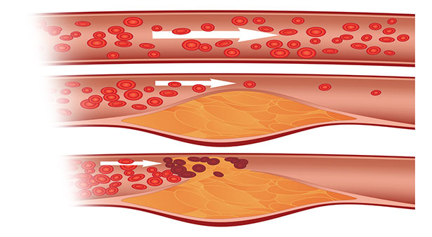 Cholesterol được cho là nguyên nhân gây ra các bệnh tắc nghẽn mạch máu và các căn bệnh tim mạch.