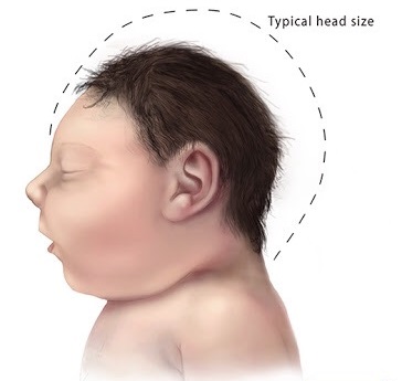 Trẻ bị dị tật não nhỏ so với não trẻ bình thường.