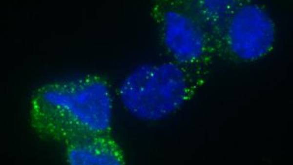 Các tế bào gốc của khối u ung thư não GMB