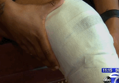 Nổ thuốc lá điện tử gây bỏng chân của Katrina. Nguồn: abc 7 NY.