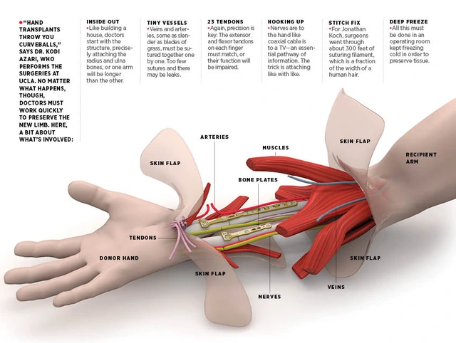 30 bác sĩ phẫu thuật trong 12 tiếng giúp người đàn ông ghép đôi bàn tay mới - Ảnh 5. 30 bác sĩ phẫu thuật trong 12 tiếng giúp người đàn ông ghép đôi bàn tay mới - Ảnh 5.