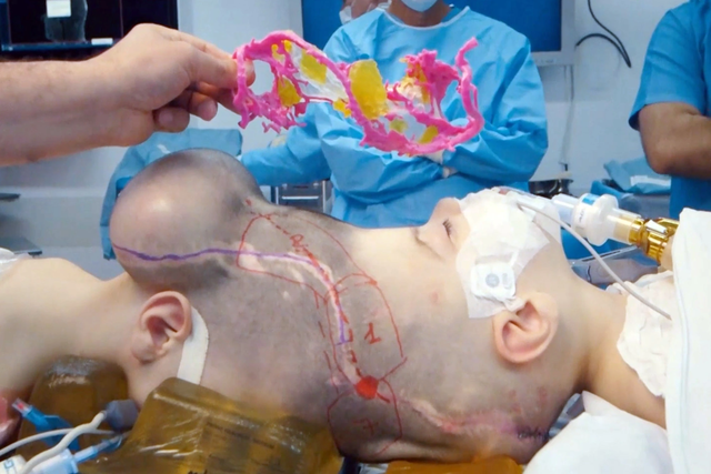 Sử dụng c&ocirc;ng nghệ thực tế ảo, c&aacute;c b&aacute;c sĩ phẫu thuật tại Anh v&agrave; Brazil t&aacute;ch đầu th&agrave;nh c&ocirc;ng cặp song sinh d&iacute;nh liền - Ảnh 2.