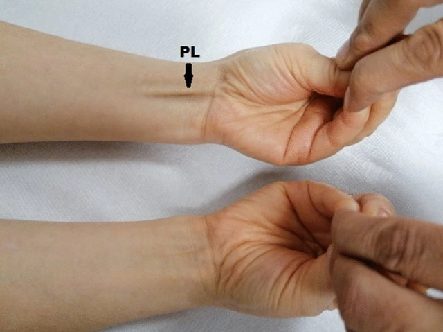 Tại sao một số người không có cơ palmaris longus? - Ảnh 3. Tại sao một số người không có cơ palmaris longus? - Ảnh 3.