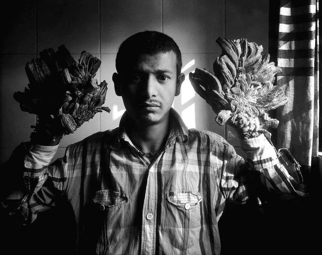 Những căn bệnh di truyền ở con người đ&aacute;ng sợ v&agrave; kinh khủng nhất từng được khoa học biết đến - Ảnh 4.