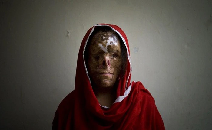 Quá trình axit đậm đặc phá hủy cơ thể con người