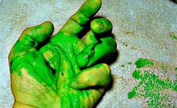 Thú vị hiện tượng máu màu xanh lá cây