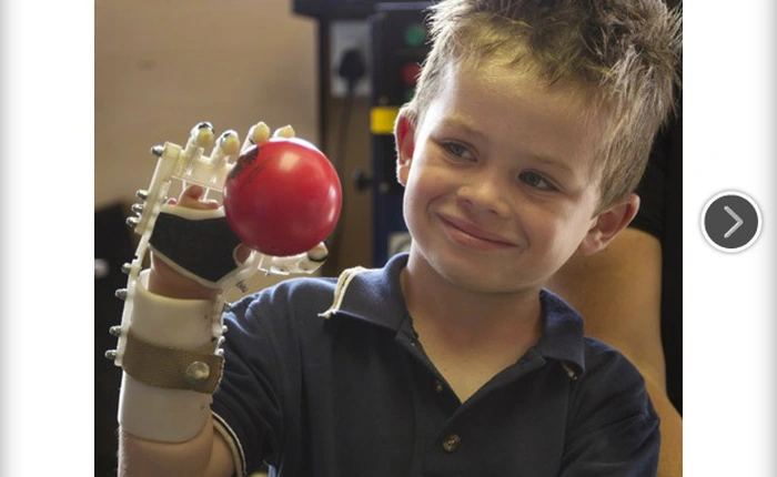 Tay giả từ máy in 3D giúp trẻ em bị khuyết tật ngón tay