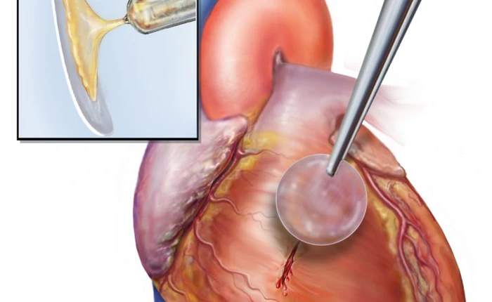 Phát minh mới - Keo có thể hàn gắn trái tim
