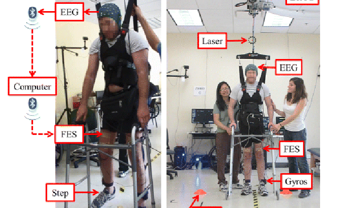 Nối thẳng hai chân lên não để chữa bại liệt