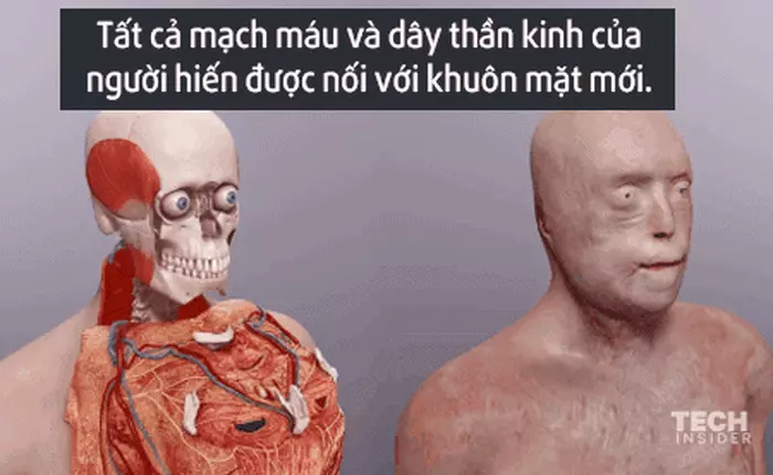 Ca phẫu thuật ghép mặt vĩ đại nhất thế giới được thực hiện như thế nào?