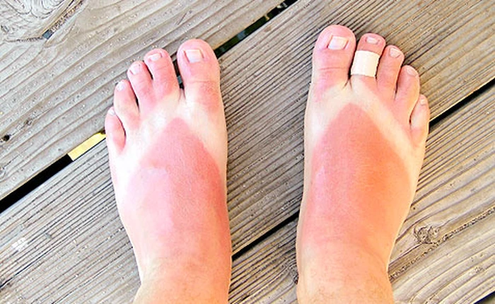 Càng đi dép tông nhiều, càng dễ "hỏng" người