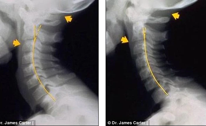 Bức ảnh gây sốc cho thấy hậu quả khi “cắm mặt vào smartphone”