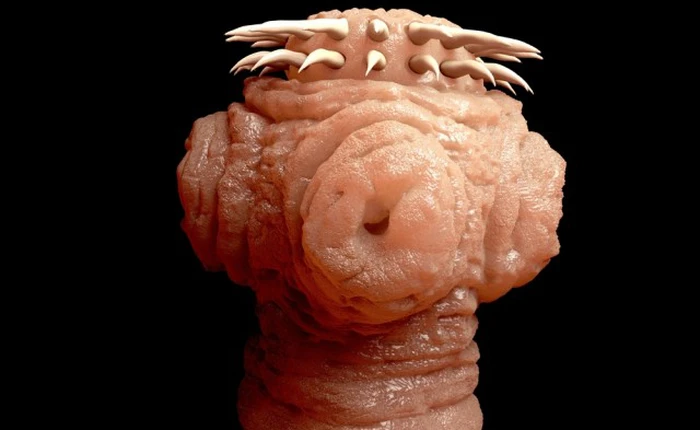 Đau đầu mãi không khỏi, đi khám phát hiện não có vật ký sinh