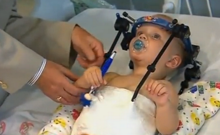 Nối lại đầu thành công cho em bé 16 tháng tuổi