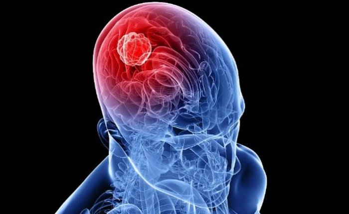 Các nhà khoa học tìm ra con đường ngăn chặn hoàn toàn ung thư não