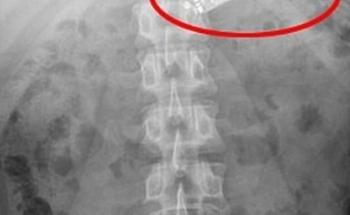 Úc: Chán đời nuốt luôn điện thoại vào bụng