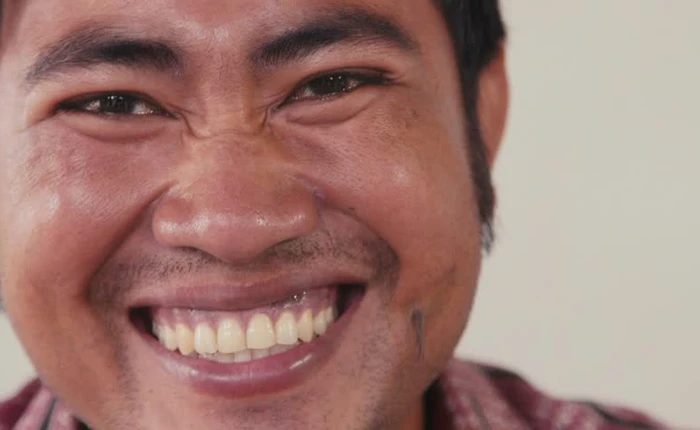 Vì sao có những người đàn ông không mọc được râu?