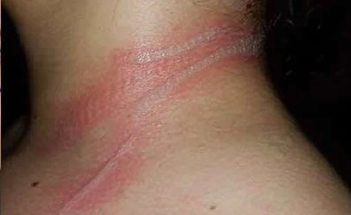 Bạn sẽ dừng ngay việc vừa sạc vừa dùng điện thoại sau khi xem những hình ảnh này