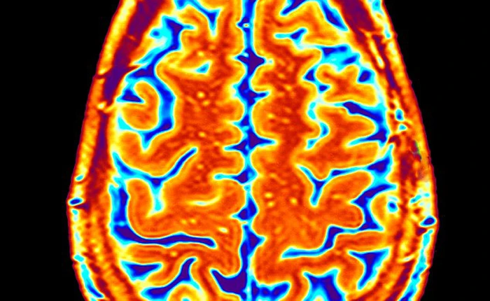 Nghiên cứu chỉ ra não của những người quá béo bị lão hóa hơn 10 năm so với người gầy