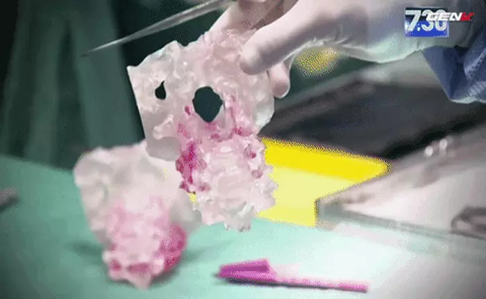 [Video] Lần đầu tiên các bác sĩ cấy ghép thành công đốt sống cổ in 3D