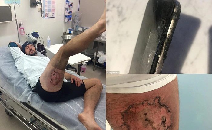 iPhone phát nổ khi va chạm, người đàn ông bị bỏng cấp độ 3