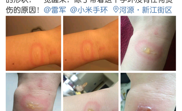 Vòng tay Xiaomi Mi Band 2 bị tố gây bỏng nặng cổ tay người dùng