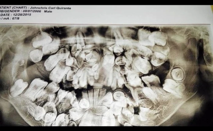 Cậu bé 9 tuổi mắc triệu chứng lạ, có tới 300 chiếc răng