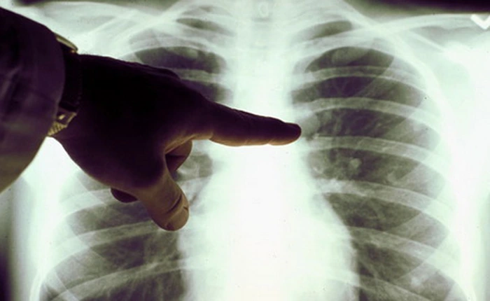 Phát hiện khối u tiềm ẩn trong cơ thể chỉ bằng cách sờ, bạn tin được không?