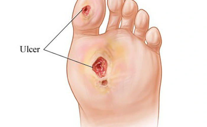 Tại sao tiểu đường dễ dẫn đến loét chân thậm chí phải cắt cụt chi?