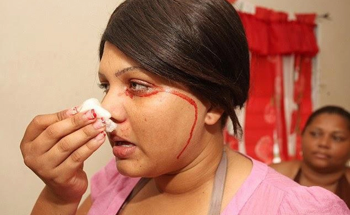 Hội chứng kỳ lạ khiến người ra “mồ hôi máu” liên tục