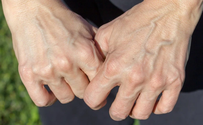 Một số người có làn da nổi gân guốc nhiều hơn hẳn phần còn lại và đây là lý do